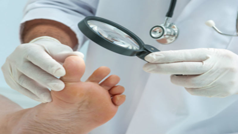 Dealing with Toe Nail Fungus? Home Remedies available in Plainfield, IL