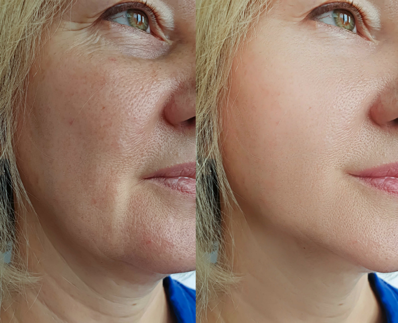 A Thread Lift Is a Safe Treatment That Can Help You Fight Aging