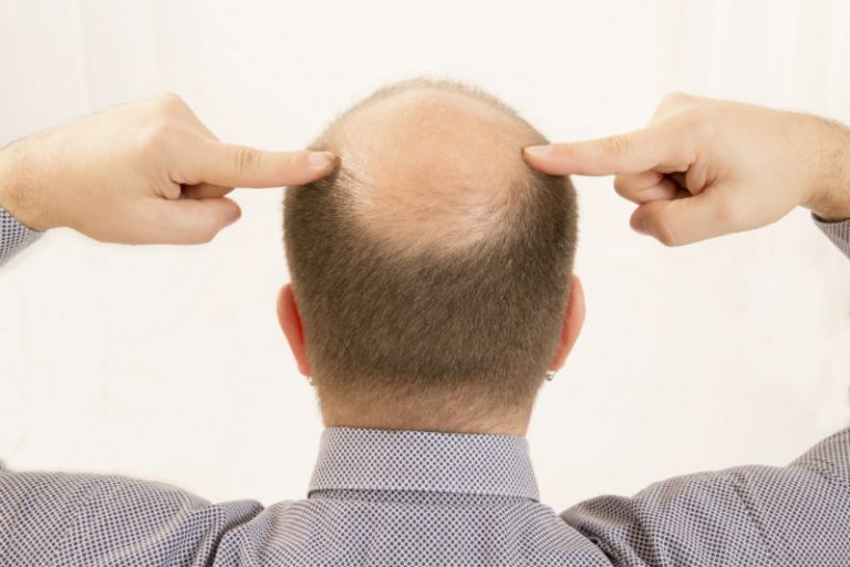 Hair Transplant: What Happens During the Surgery